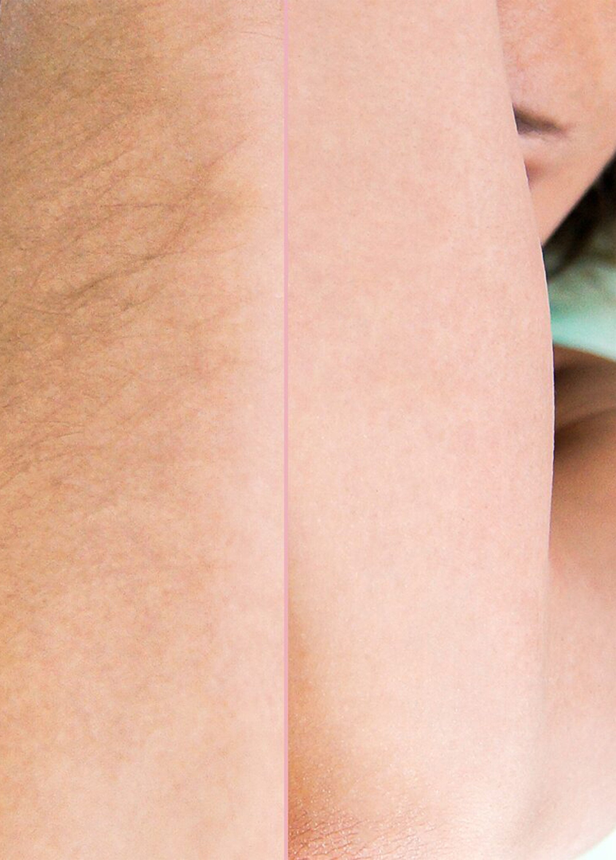 Réducteur de pilosité visage Epil Xpress REDUCTEUR PILOSITE GILETIER DE1